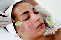 ACNE тяжелой формы